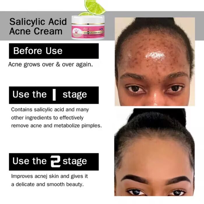EASYGLOWING Salicylic Acid Acne Cream 50g - Image 3